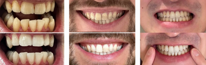 Teeth Whitening Powder – Fresh Breath & Clean Smile – 30gram